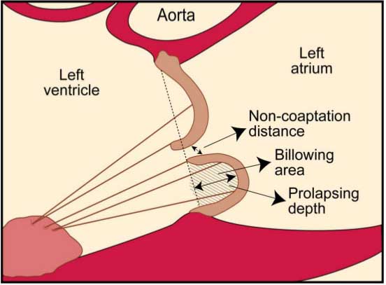 پرولاپس دریچه میترال