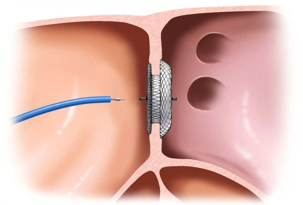 بستن سوراخ ASD با اینترونشن
