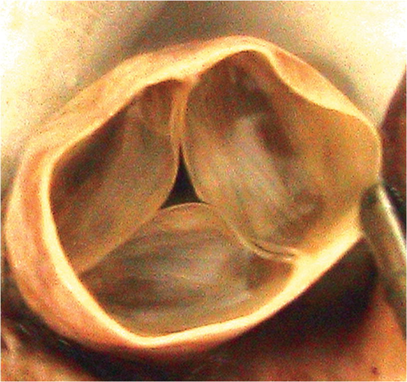 دریچه پولمونری (ریوی) 🔗