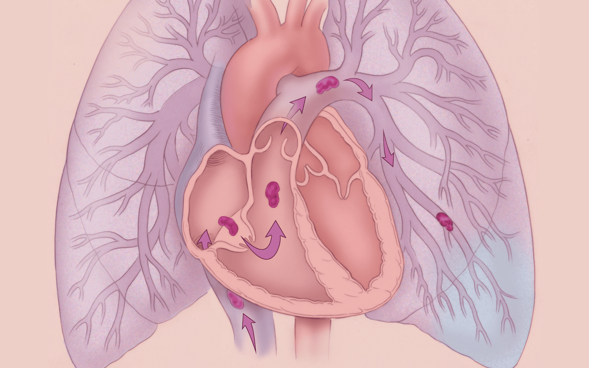 آمبولی ریه 🔗