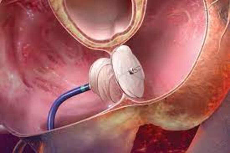 چه زمانی لازم است PFO بسته شود؟